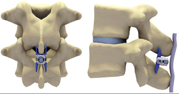 Minimally Invasive Treatment Of Moderate Lumbar Spinal Stenosis With ...