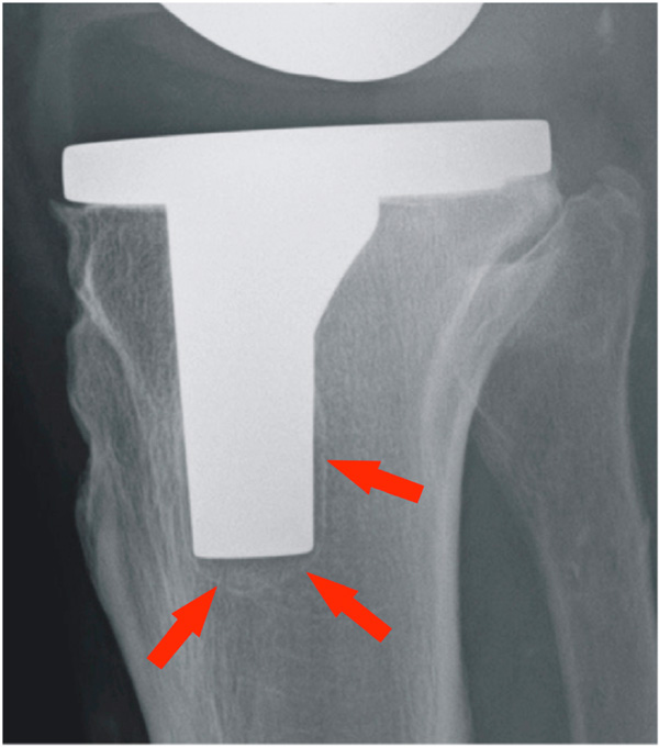 Navigated Cementless Total Knee Arthroplasty Medium Term Clinical And