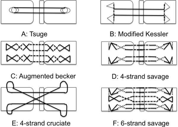 an overview of the management of flexor tendon injuries