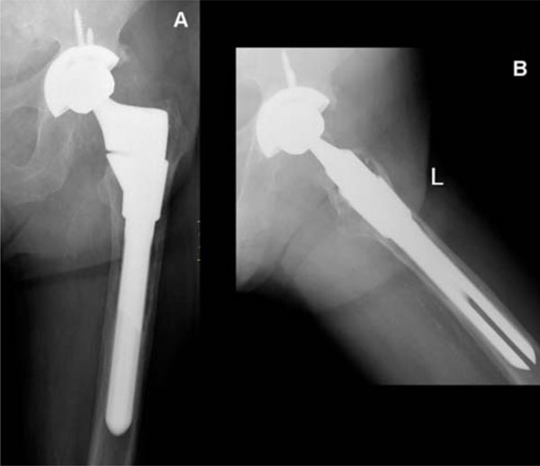 OneStage Revision Arthroplasty for Infected Hip Replacements