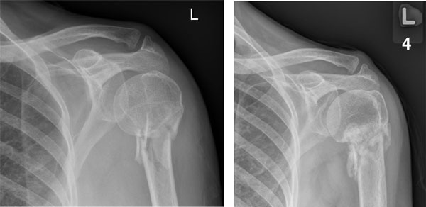 A Review of Management Options for Proximal Humeral Fractures ~ Fulltext