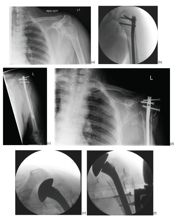 The Humelock Hemiarthoplasty Device for Both Primary and Failed ...