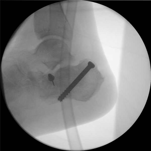 A Novel Surgical Technique for Removing Buried Cannulated Screws Using ...