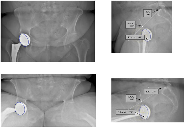 Total Hip Prostheses in Standing, Sitting and Squatting Positions: An ...