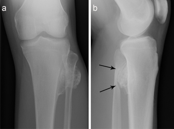 Osteochondroma-Related Pressure Erosions in Bony Rings Below the Waist