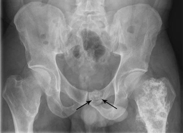 Osteochondroma-Related Pressure Erosions in Bony Rings Below the Waist