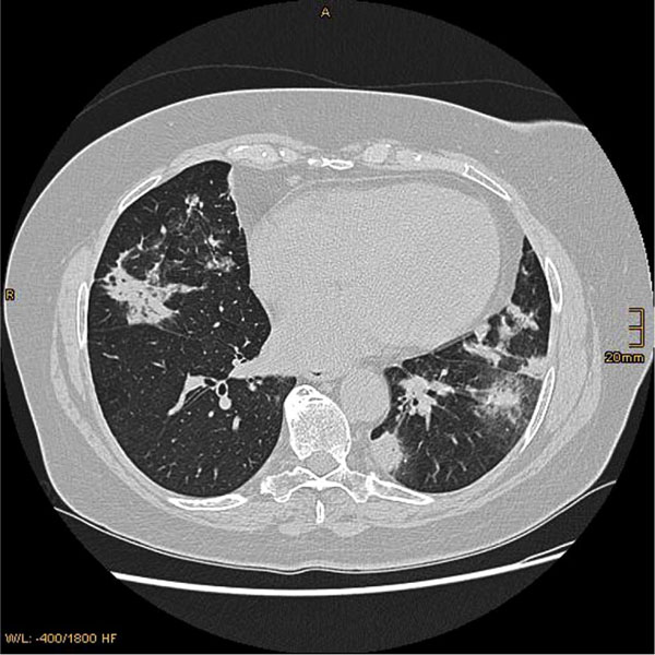Featured image of post Radiopaedia Organizing Pneumonia Histologically both cryptogenic organizing pneumonia and secondary organizing pneumonia are characterized by polypoid fibroblastic aggregations which plug alveolar sacs ducts and bronchioles