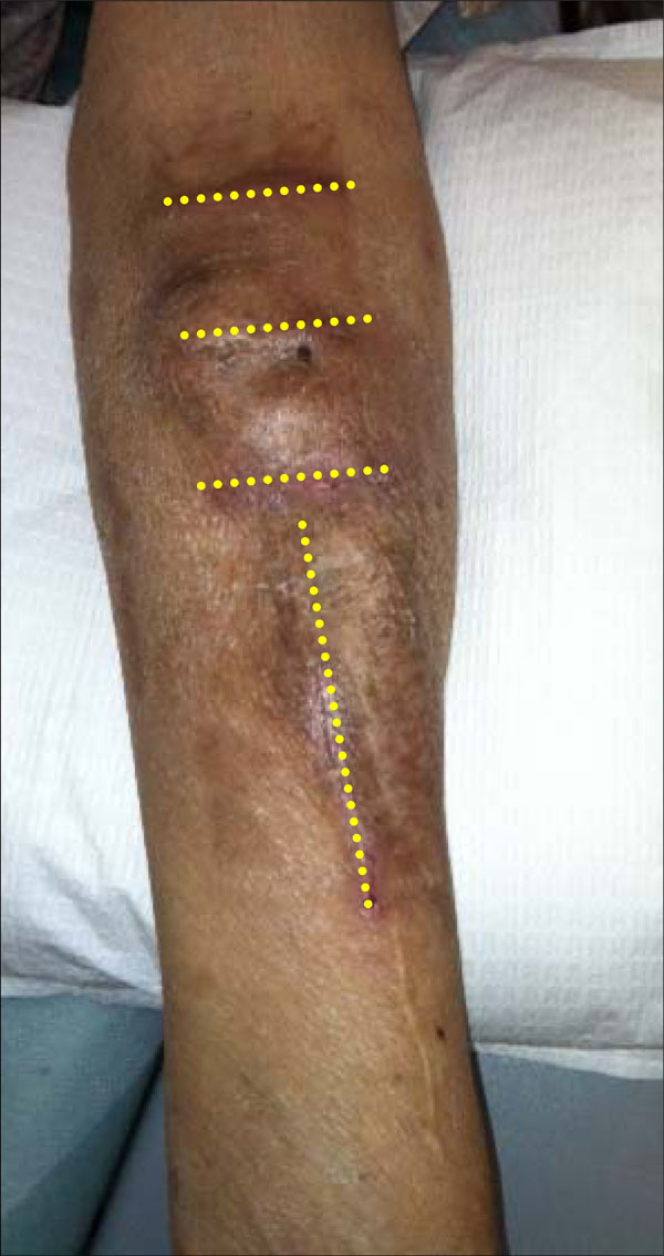 aneurysmal-dilatation-of-dialysis-arteriovenous-access-fulltext