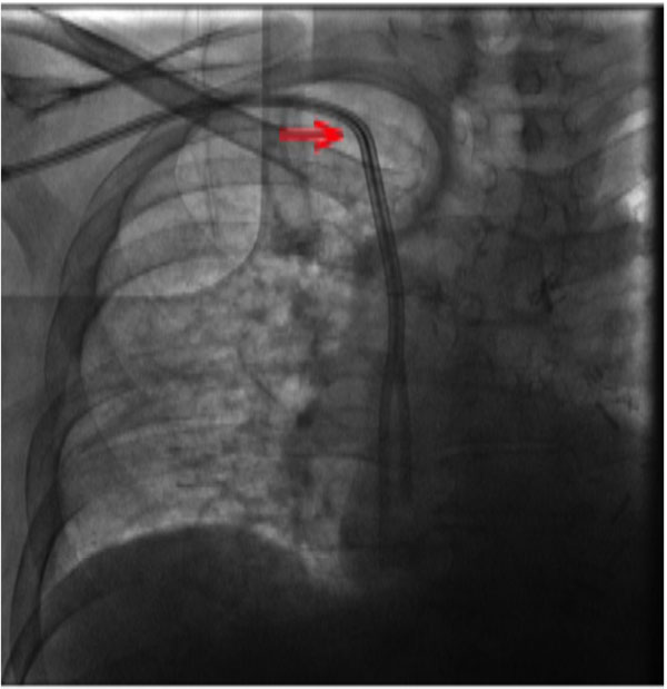 Subclavian or Internal Jugular Tunneled Dialysis Catheter Can we Divulge the Location? Fulltext