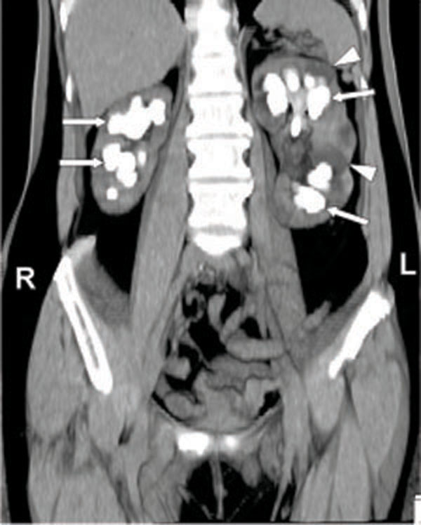 Learning From Images Staghorn Calculi